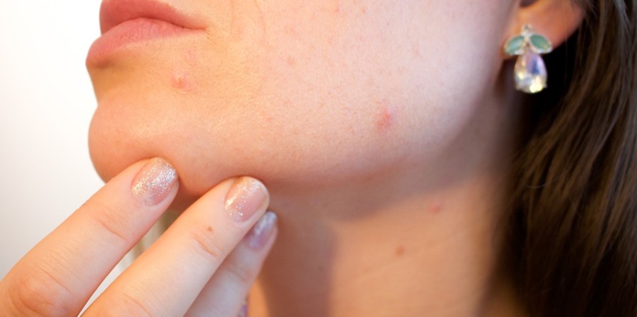 acne-1606765_960_720