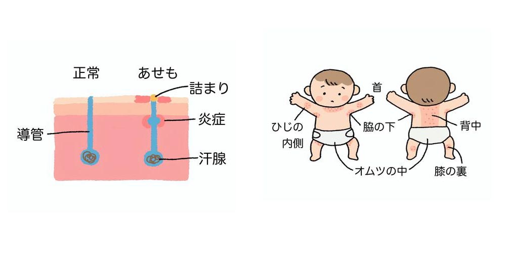 あせものメカニズムとあせもができやすい体の部位のイラスト