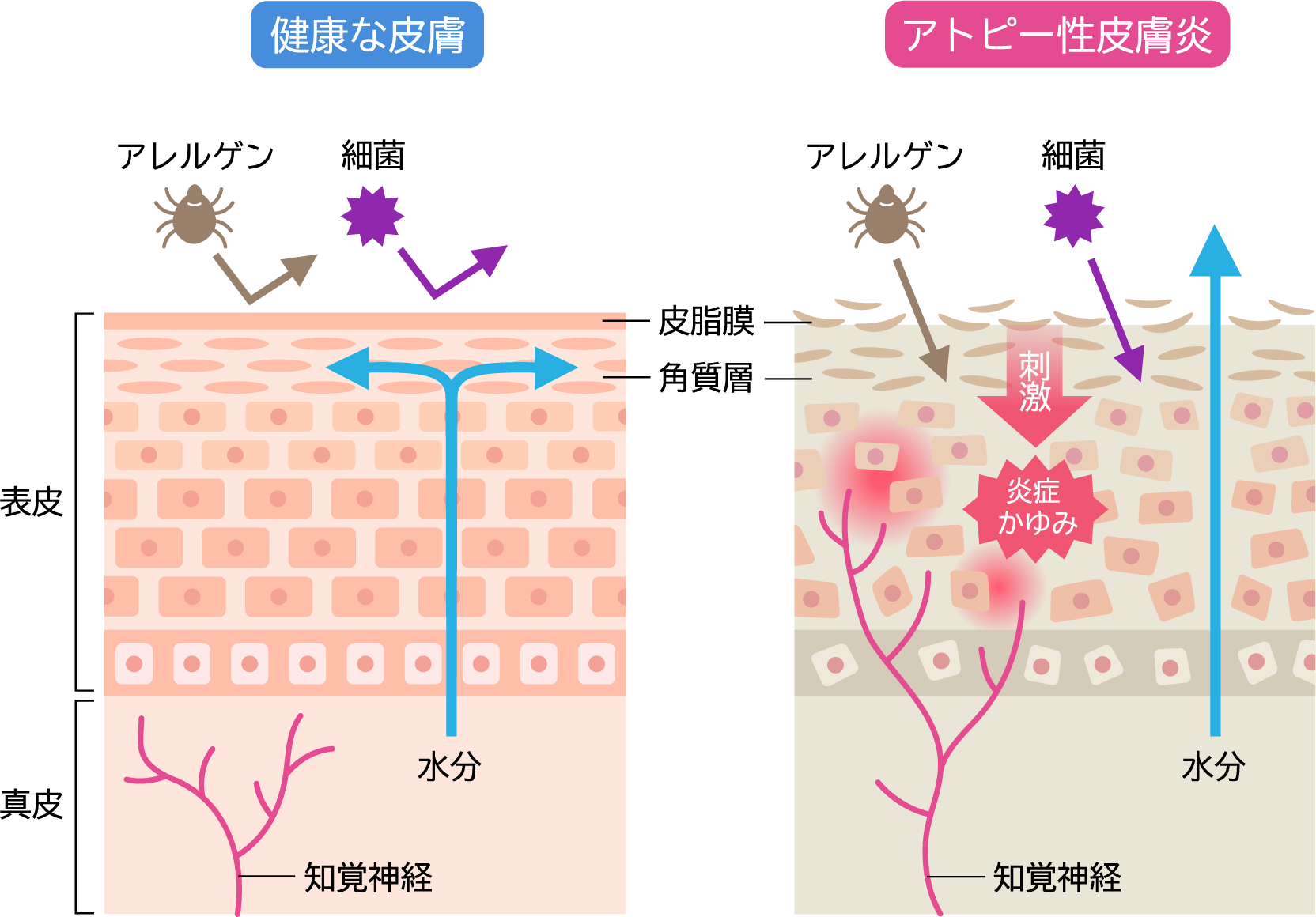 アトピー性皮膚炎のメカニズムの図