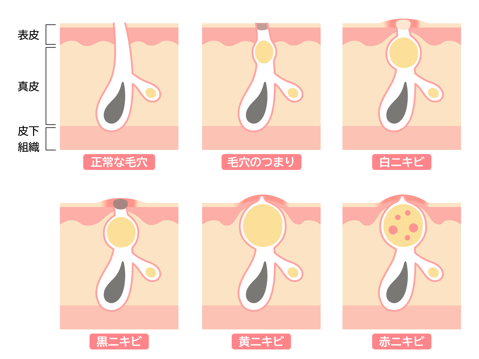 ニキビのメカニズムのイラスト