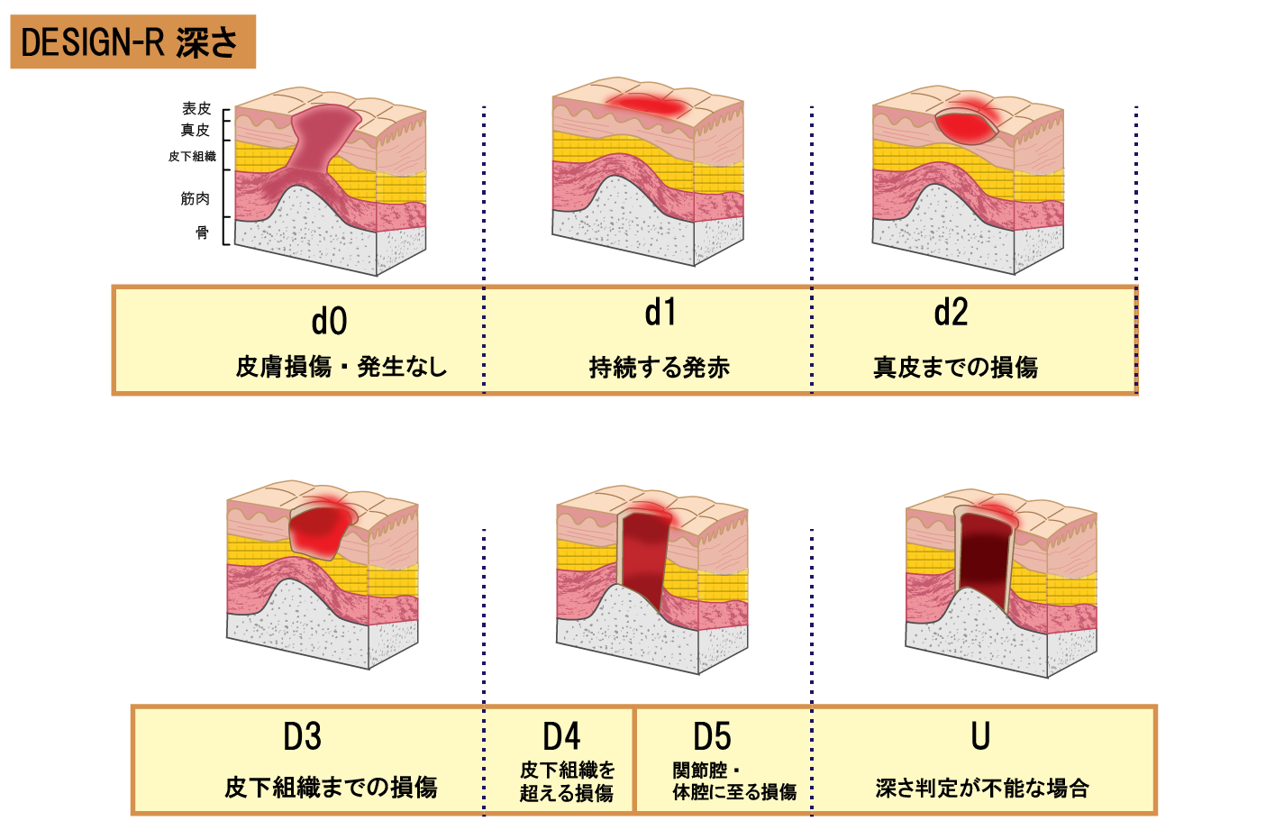 床ずれの進行度合いの図